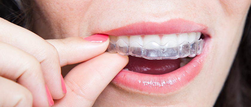 Invisalign vs Braces: Which One is Right for You?