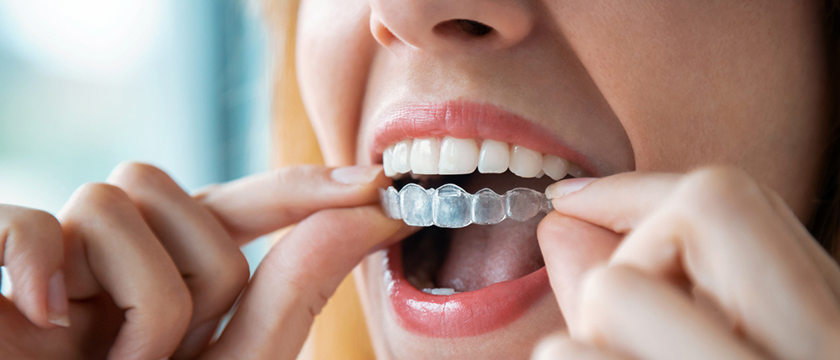 Comparing Invisalign vs. Braces: Which is Best for You?