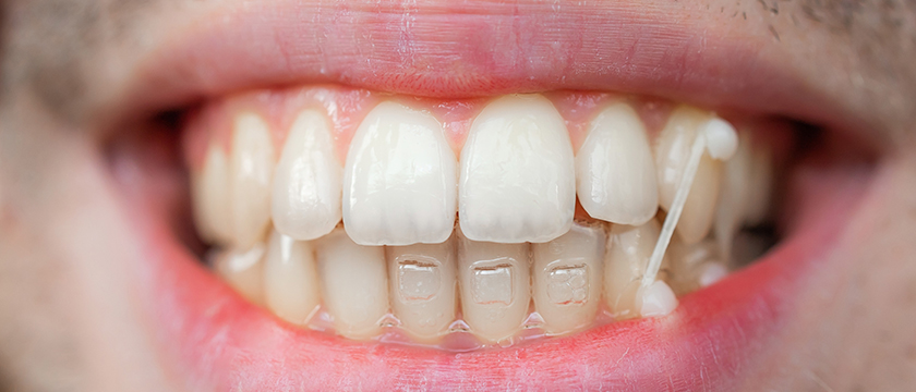 Does Invisalign Use Rubber Bands? - Trillium Smile Dentistry