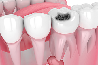 tooth decay Mississauga