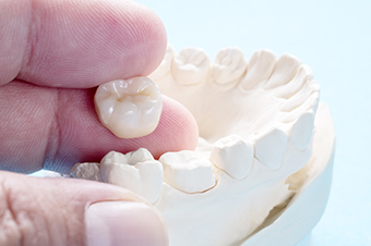 Dental Crowns in Mississauga